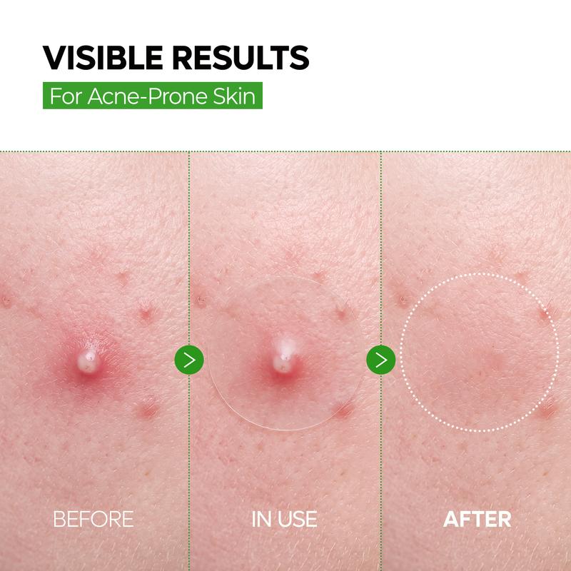Dr. Melaxin ZERO-FIT™ Korean 2-Step Blemish System